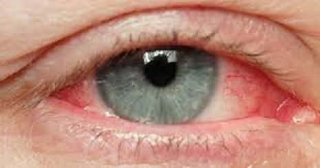 التهاب العين بفصل الصيف أسبابه وكيفية علاجه