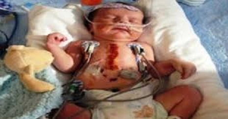 طفل بأمريكا يولد بنصف قلب فيلجأ لعملية جراحية خطيرة