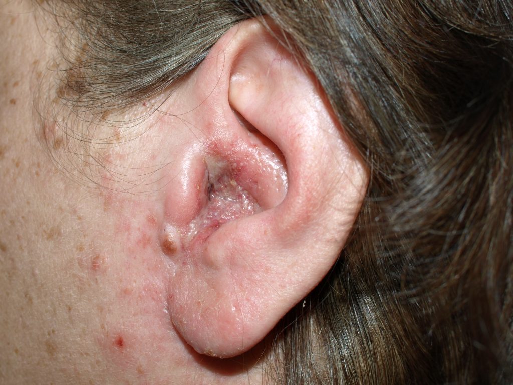 لإلتهاب الأذن أنواع وأعراض تعرف عليها