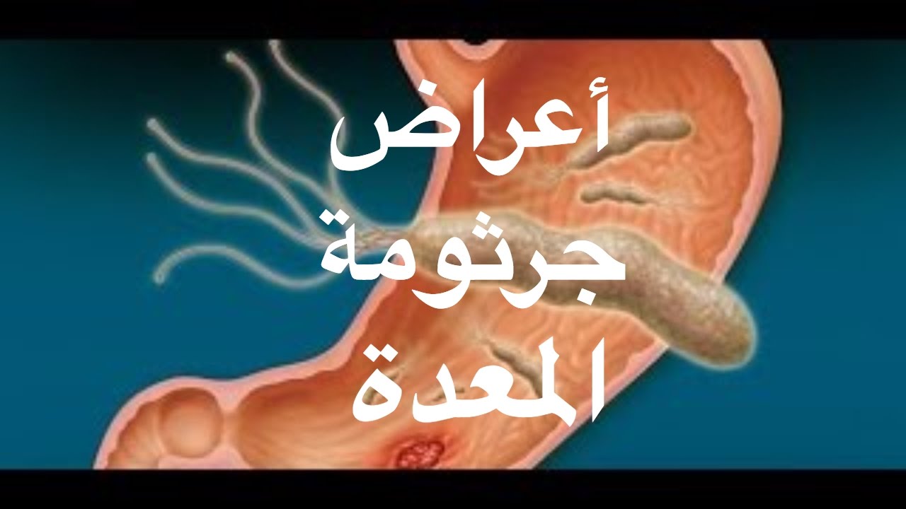 تعرف على الإصابة بجرثومة المعدة وطرق الوقاية