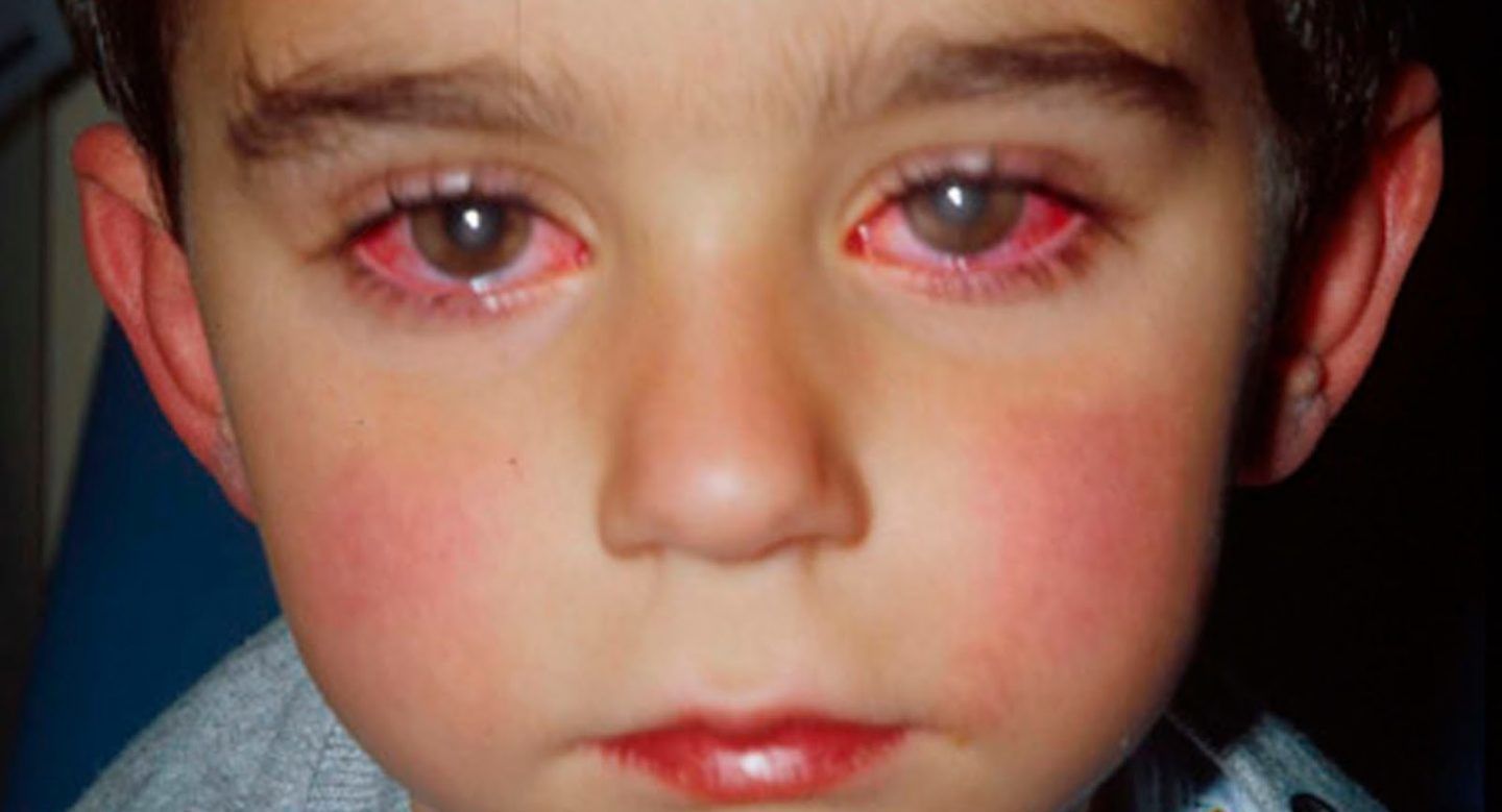 تعرف على أسباب إصابة الأطفال بالعين الوردية