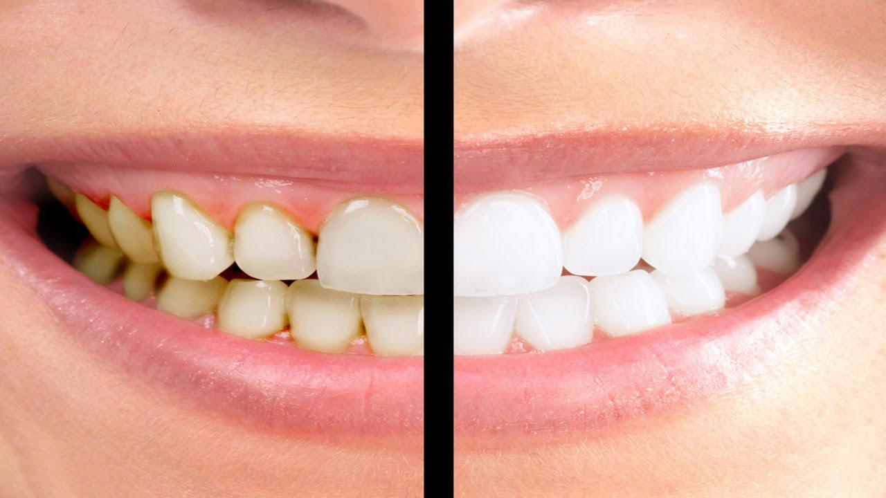 تعرف على أسباب إصفرار الأسنان وطرق علاجها