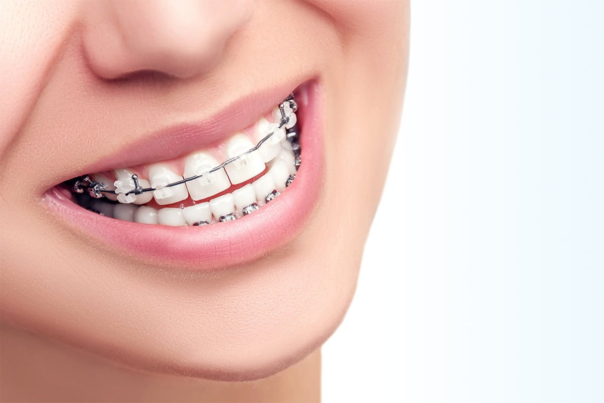عيوب وأنواع تقويم الأسنان الداخلي الشفاف للأطفال والكبار
