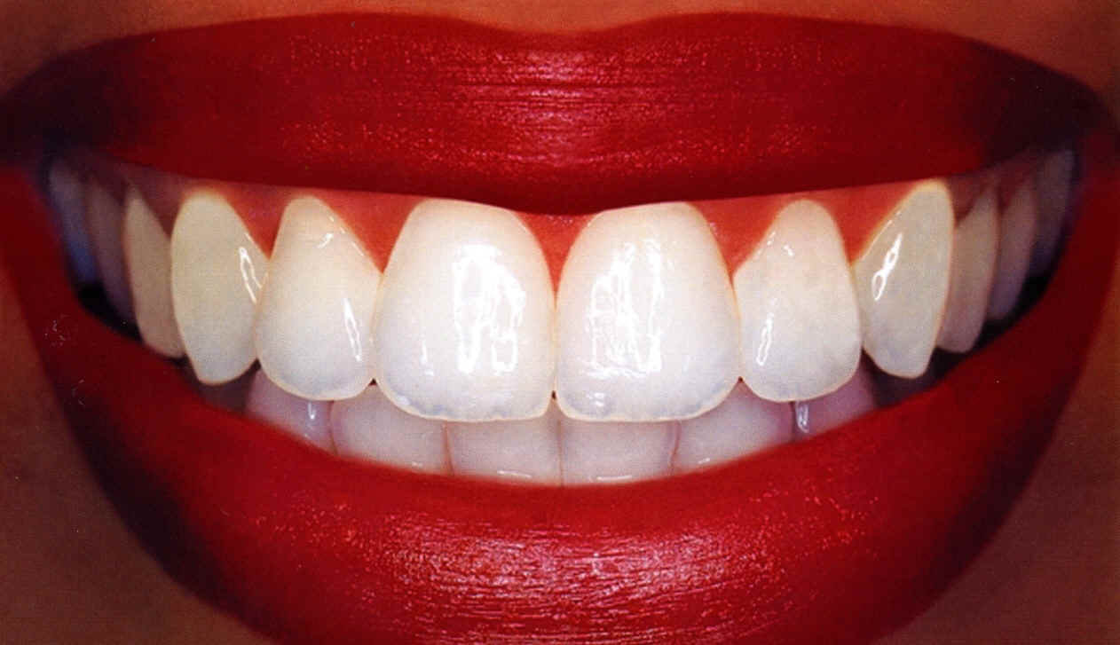 انقذ اسنانك أسرع خلطة تبييض الاسنان والتخلص من الجير والتراسبات بشكل نهائي