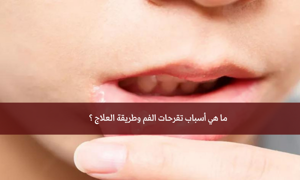 ما هي أسباب تقرحات الفم وطريقة العلاج ؟