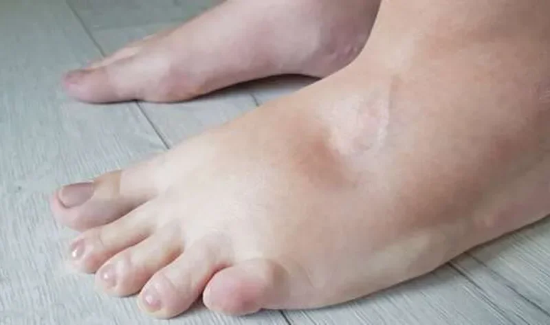 انتفاخ القدمين قد يكون علامة على مرض خطير.. اذهب للطبيب فورا عند ظهور الأعراض – منوعات